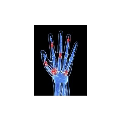 For Rheumatoid Arthritis Patients, Remission Does Not Always Mean Remission