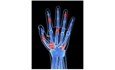 For Rheumatoid Arthritis Patients, Remission Does Not Always Mean Remission