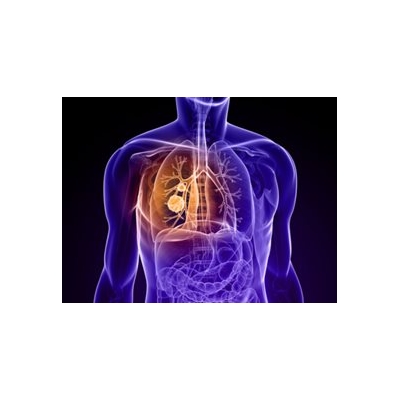 Telomeres Might Predict Lung Cancer Recurrence