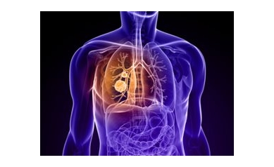 Telomeres Might Predict Lung Cancer Recurrence