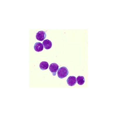 Lab Pinpoints New Drug Target for Infant Leukemia