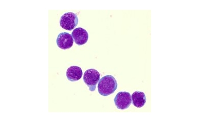 Lab Pinpoints New Drug Target for Infant Leukemia
