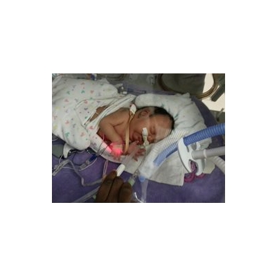 Baby Girl Overcomes Multiple Medical Obstacles