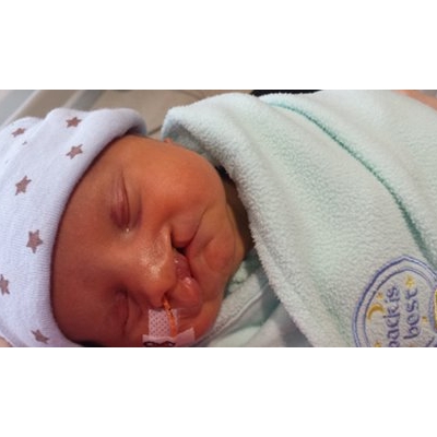 Mom is Happy Cleft Lip Care for Baby is Better than She Had