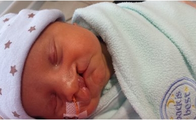 Mom is Happy Cleft Lip Care for Baby is Better than She Had