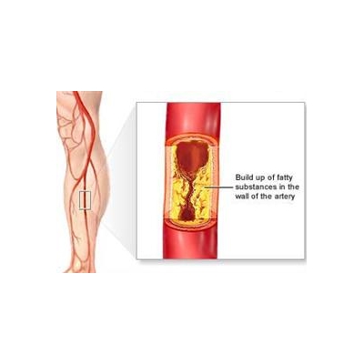 University of Rochester Medical Center Offers Free Screening for Vascular Disease