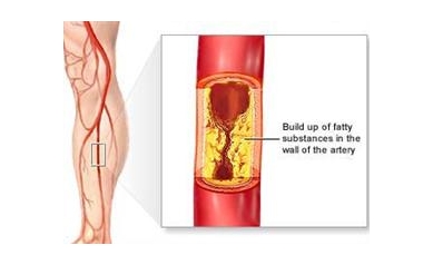 University of Rochester Medical Center Offers Free Screening for Vascular Disease