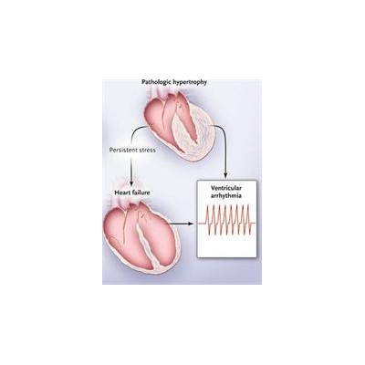 Viagra Relatives Shrink Abnormally Large Hearts