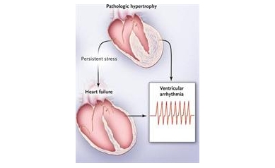 Viagra Relatives Shrink Abnormally Large Hearts