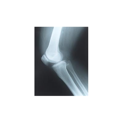 Rochester Study:  Women with Breast Cancer Have Low Vitamin D Levels