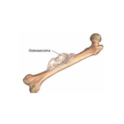 Approved Lymphoma Drug Shows Promise in Early Tests Against Bone Cancer
