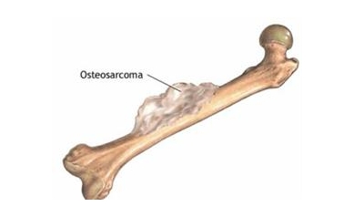Approved Lymphoma Drug Shows Promise in Early Tests Against Bone Cancer