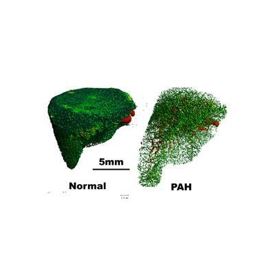 Breathlessness Eased in Patients with Rare, Often Fatal Disease