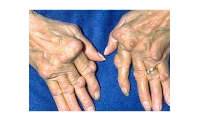 As Hopes for Early Arthritis Detection Improve, Local Clinic Acts Fast to Save Joints