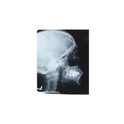 Decades after Childhood Radiation, Thyroid Cancer a Concern