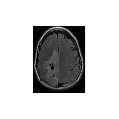 Researchers Pinpoint Origin of Deadly Brain Tumor