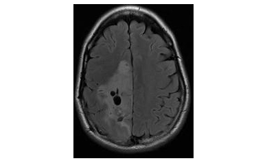 Researchers Pinpoint Origin of Deadly Brain Tumor