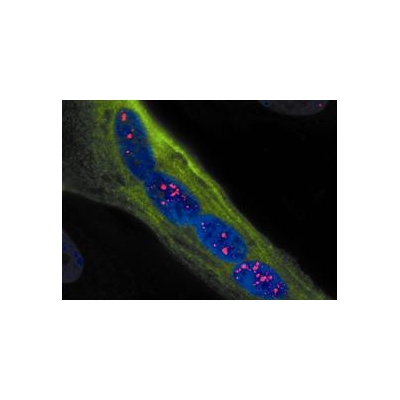 Some Muscular Dystrophy Patients at Increased Risk for Cancer