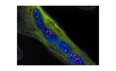 Some Muscular Dystrophy Patients at Increased Risk for Cancer