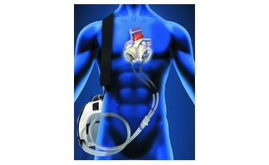 URMC Surgeons Implant 1st Total Artificial Heart in Upstate New York