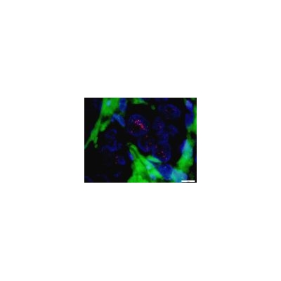 URMC First in Region to Offer HER2 FISH Testing for Breast Cancer