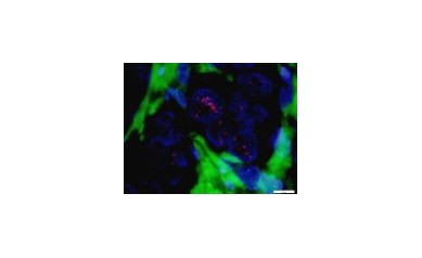 URMC First in Region to Offer HER2 FISH Testing for Breast Cancer