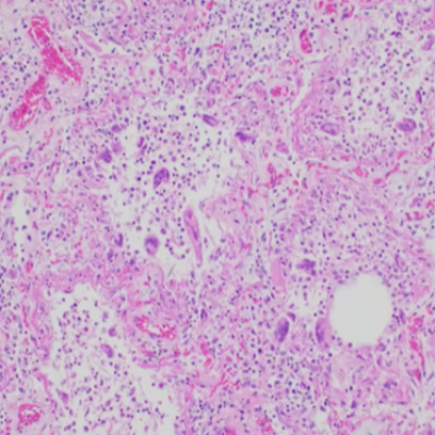 COVID Positive Lung