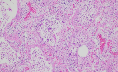 COVID Positive Lung