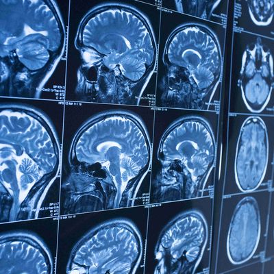 URMC to Launch New Brain Aging Research Center
