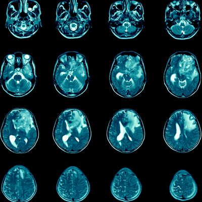 Personalized Immune Therapy Extended Survival in Patients with Aggressive Brain Cancer 