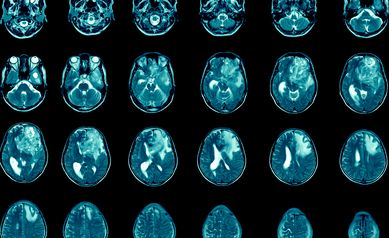 Personalized Immune Therapy Extended Survival in Patients with Aggressive Brain Cancer 