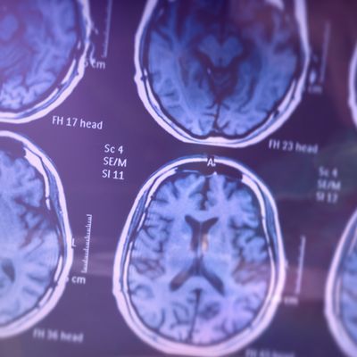 AD brain images