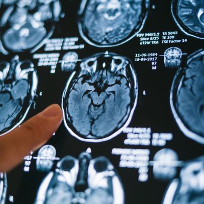 MRI stroke