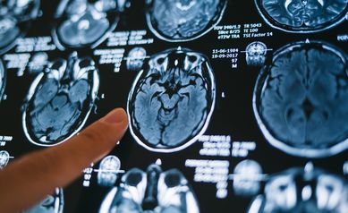 MRI stroke
