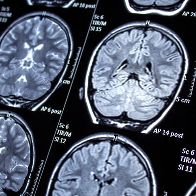 brain scans