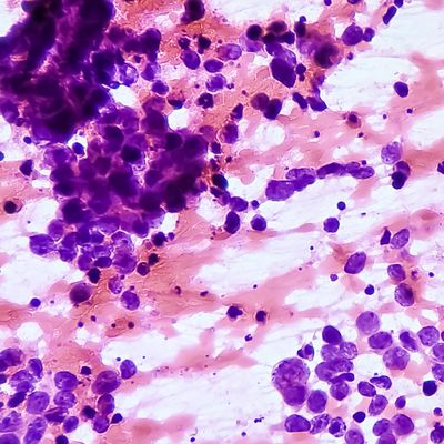 lab-profile-Rappold Lab -- renal cell carcinoma