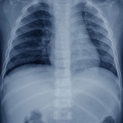 Is Pneumonia Contagious?