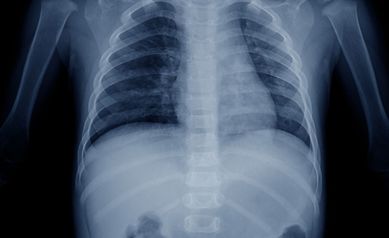 Is Pneumonia Contagious?