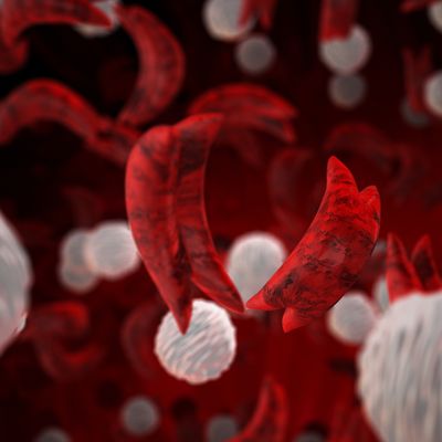 Sickle Cell Image