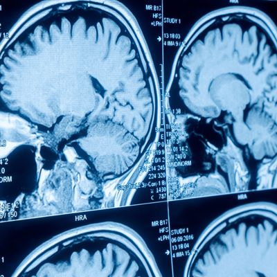 Researchers Uncover Possible New Biomarker for Psychosis Diagnosis
