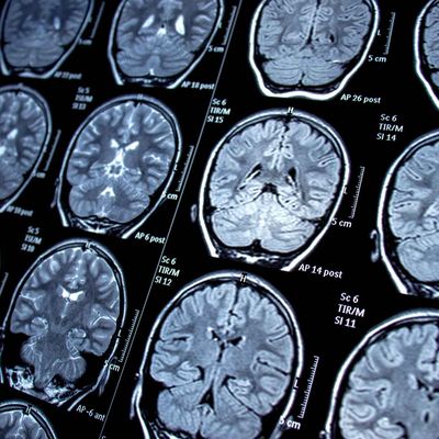 MRI Brain_1_11zon