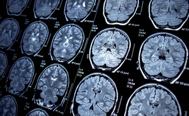 MRI Brain_1_11zon