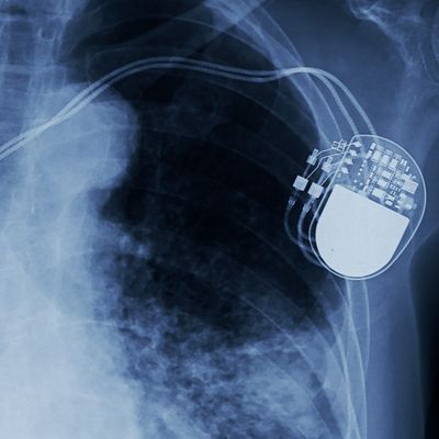 x-ray image of permanent pacemaker implant in chest body , process in blue tone