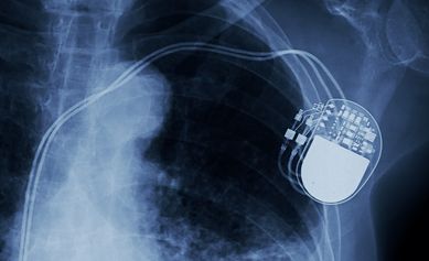 URMC Heart Researchers Launch $27M ICD Study 