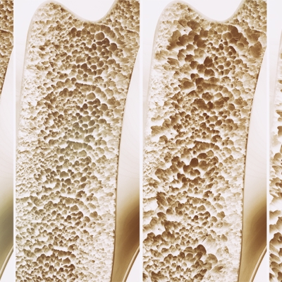 Eliseev progression of bone loss