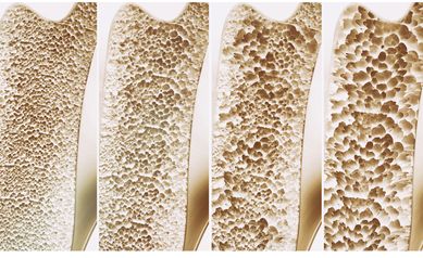 UR Scientists Working to Crack Enduring Mystery of Bone Loss, Regeneration