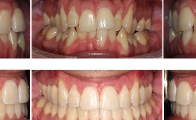 gum recession pic