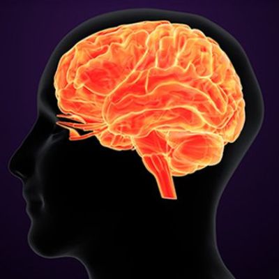 Why Are Strokes Increasing in Young Adults?