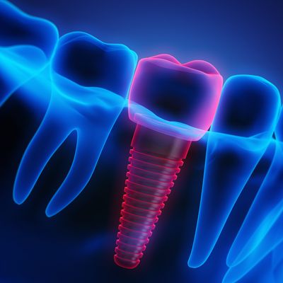 Eastman Institute Awarded $2.9 Million to Study Dental Implant Failures