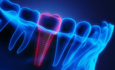 Eastman Institute Awarded $2.9 Million to Study Dental Implant Failures